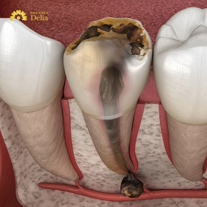 Hoại tử tủy là giai đoạn tiến triển nặng hơn của viêm tủy răng, khi mà các mô tủy bị chết do thiếu hụt oxy và chất dinh dưỡng.
