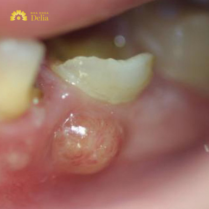 Áp xe chóp răng là tình trạng nhiễm trùng lan từ tủy răng xuống chóp răng, gây ra áp xe tại vị trí này