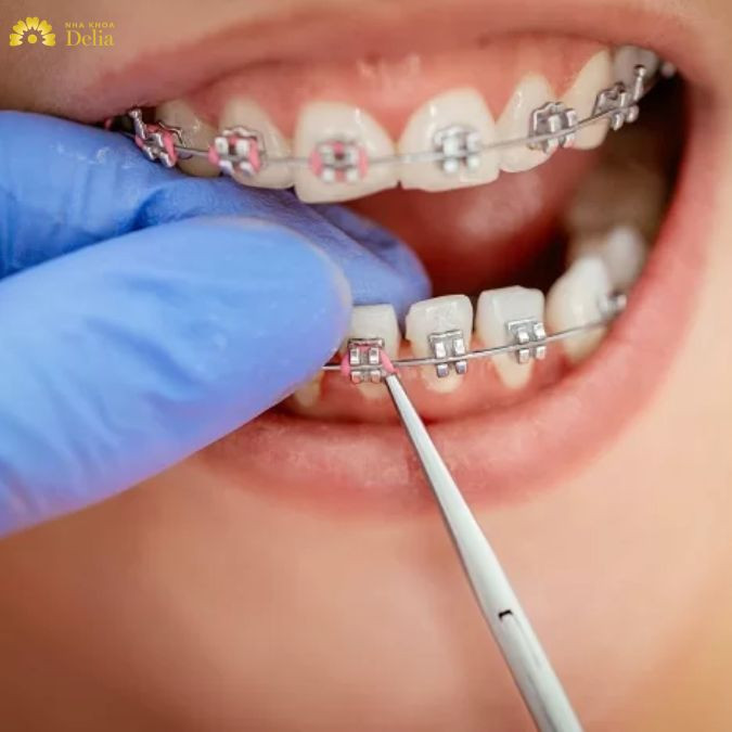 Tháo mắc cài