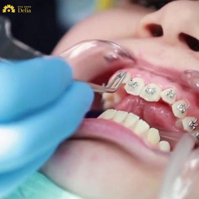 Gắn mắc cài