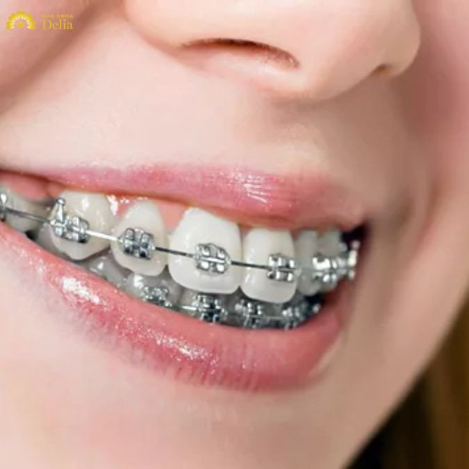 Niềng răng mắc cài kim loại là phương pháp chỉnh nha truyền thống, được sử dụng rộng rãi và phổ biến nhất hiện nay