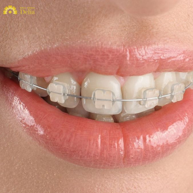 Mắc cài sứ có độ bền cao, chịu lực tốt, giúp răng di chuyển ổn định và hiệu quả