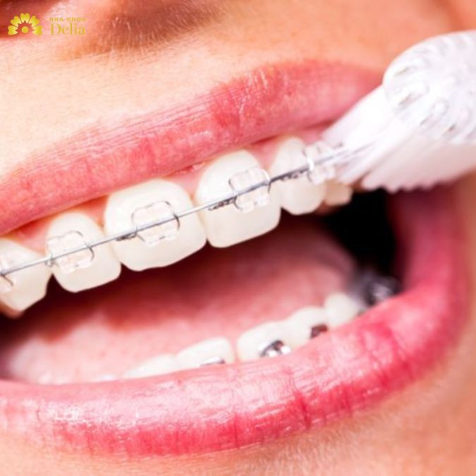ưu điểm nổi bật nhất của mắc cài sứ chính là tính thẩm mỹ