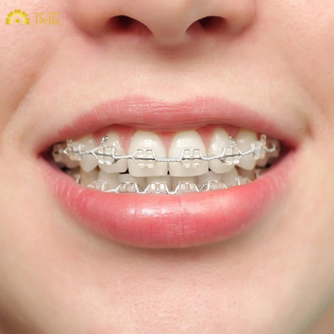 Mặc dù có độ bền cao nhưng mắc cài sứ vẫn có thể bị vỡ nếu chịu tác động lực quá lớn