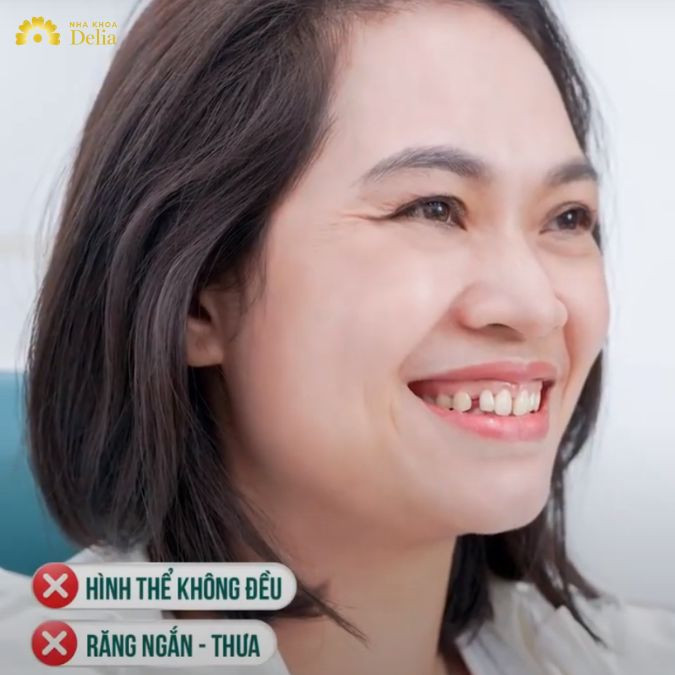 Hình thể răng không đều, thưa, ngắn và nụ cười hở lợi khiến chị vô cùng tự ti