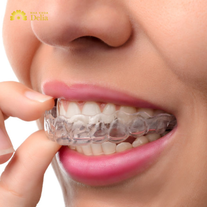 Với ngân sách 40 triệu đồng, bạn có nhiều lựa chọn tốt để niềng răng với các phương pháp hiện đại và hiệu quả