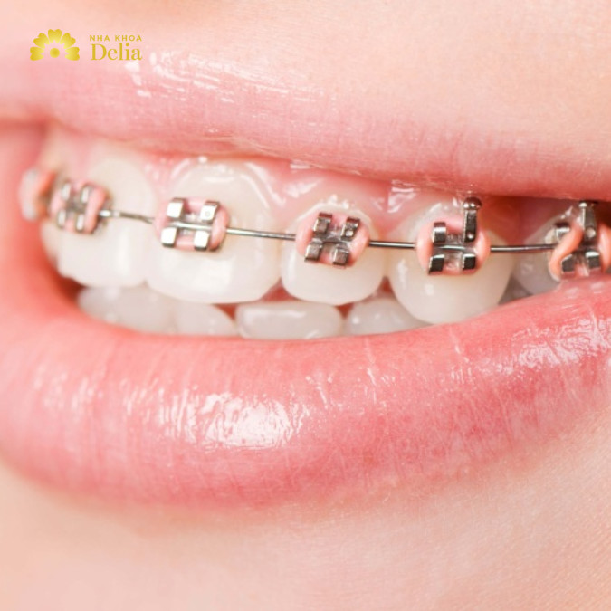 Niềng răng bao nhiêu tiền 1 hàm? Giá đắt hay rẻ?