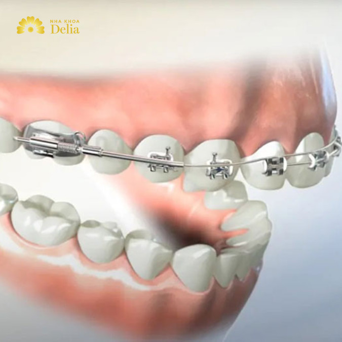 Chi phí niềng răng 1 hàm thông thường sẽ được tính bằng 1 nửa so với chi phí niềng răng cả 2 hàm.