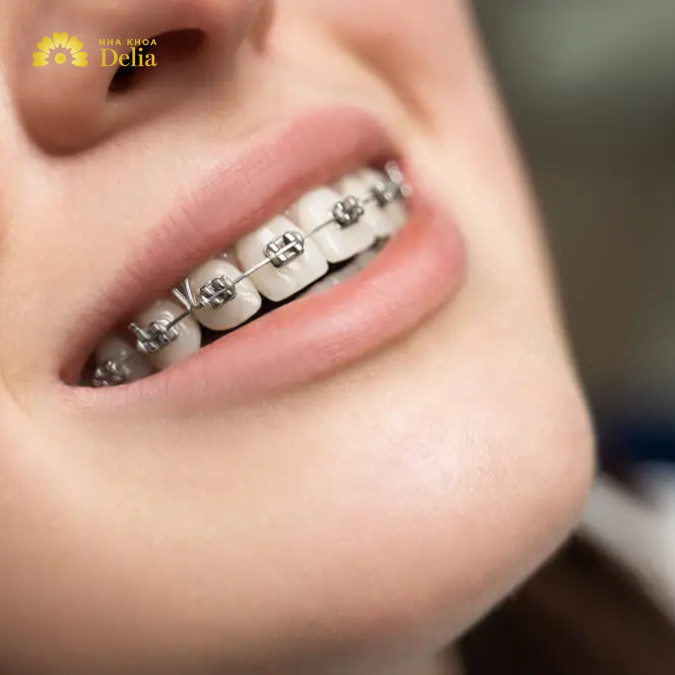 Tại Hà Nội, niềng răng trung bình có mức giá từ 30 - 120 triệu/liệu trình