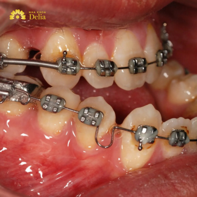 Niềng răng bị quặp vào trong bao nhiêu tiền, đắt hay rẻ?