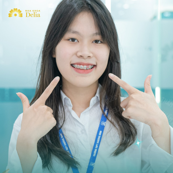 Niềng răng là một trong những thủ thuật chỉnh nha phổ biến nhất, được sử dụng để cải thiện sự sắp xếp của răng và khớp cắn