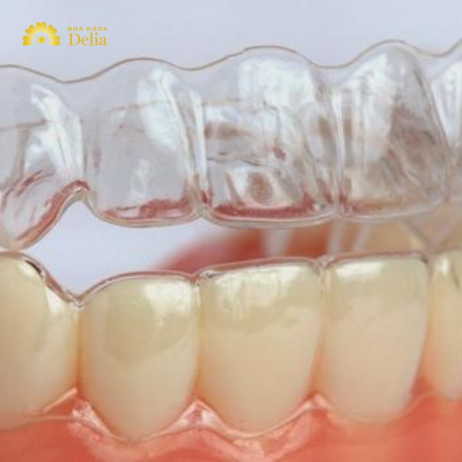 Để đảm bảo hiệu quả điều trị, bạn nên đeo khay niềng ít nhất 20-22 giờ mỗi ngày
