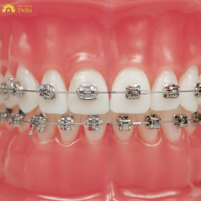 Thông thường, bạn sẽ cần tái khám định kỳ 4-6 tuần/lần để bác sĩ kiểm tra tình hình di chuyển của răng