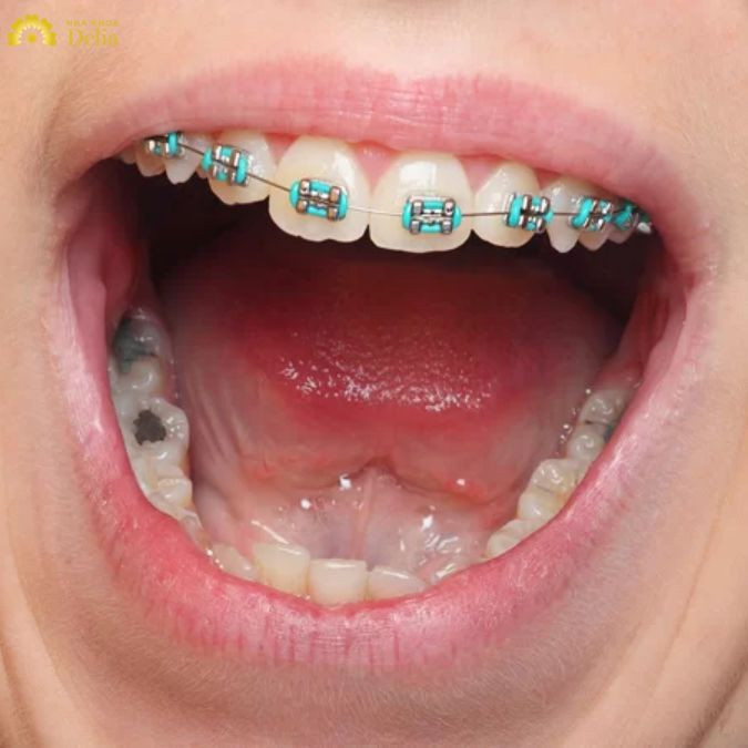 Niềng răng là một quá trình đòi hỏi sự phối hợp chặt chẽ giữa bác sĩ và bệnh nhân