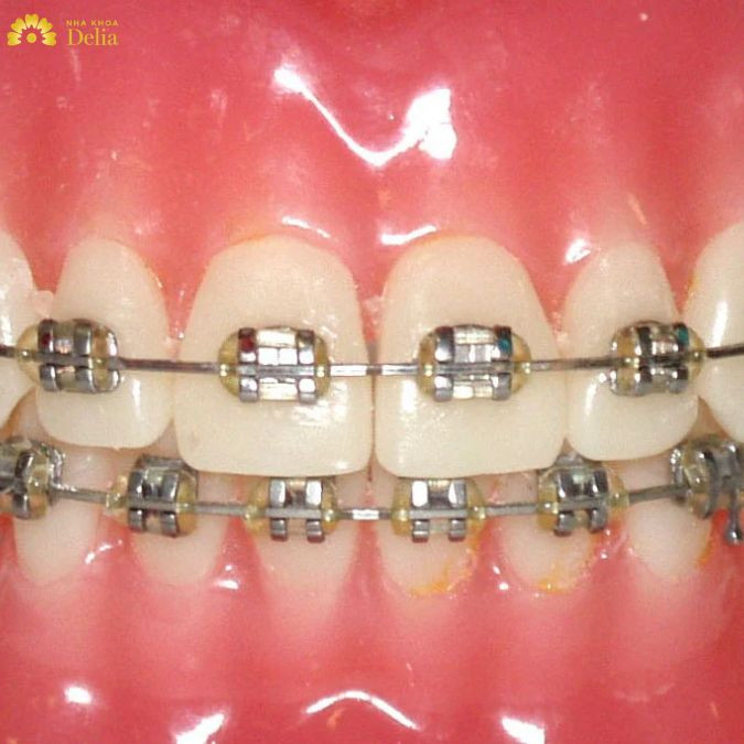 Thời gian niềng răng mắc cài kim loại thường kéo dài từ 18-24 tháng