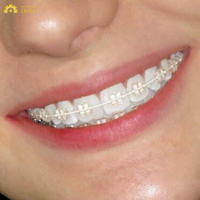 Niềng răng mắc cài sứ là phương pháp chỉnh nha hiện đại sử dụng hệ thống mắc cài được làm từ chất liệu sứ cao cấp