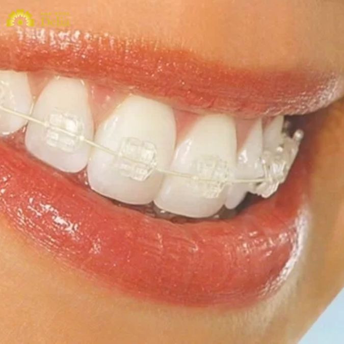 Mắc cài pha lê: Độ bền thấp hơn, dễ bị vỡ khi va chạm mạnh