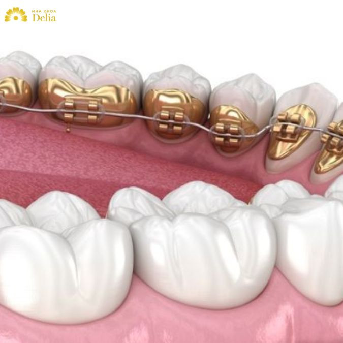 Nhờ việc gắn mắc cài vào mặt trong răng, người niềng có thể tự tin cười nói mà không lo bị lộ khí cụ niềng răng