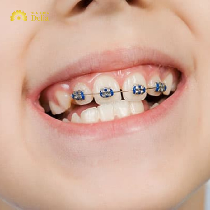Niềng răng mặt bao nhiêu tiền, phương pháp niềng nào phù hợp?