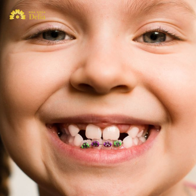 Niềng răng mặt có mức giá trung bình từ 30 - 120 triệu, phụ thuộc chủ yếu vào phương pháp niềng răng mà bạn lựa chọn.