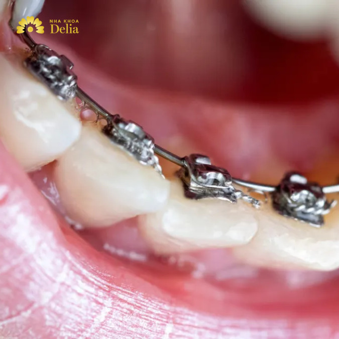 Niềng răng mặt trong thường có chi phí và thời gian điều trị dài hơn do yêu cầu cao hơn về kỹ thuật