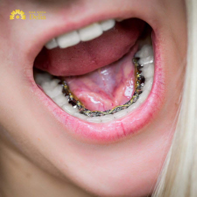 Niềng răng mặt trong có mức giá trung bình từ 85.000.000 - 125.000.000 VNĐ cho cả 2 hàm, tùy vào mức độ xô lệch của răng mà giá thành sẽ thay đổi khá nhiều.