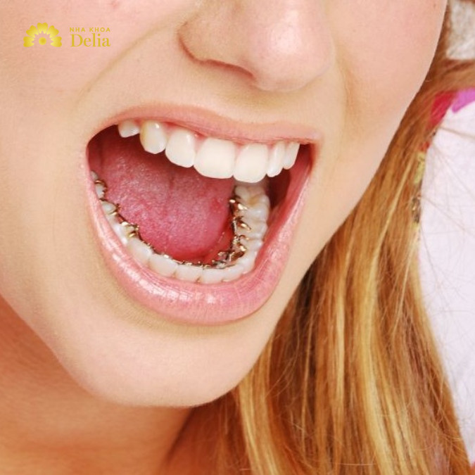 Tình trạng răng xô lệch có thể ảnh hưởng đáng kể đến mức chi phí khi niềng răng mặt trong