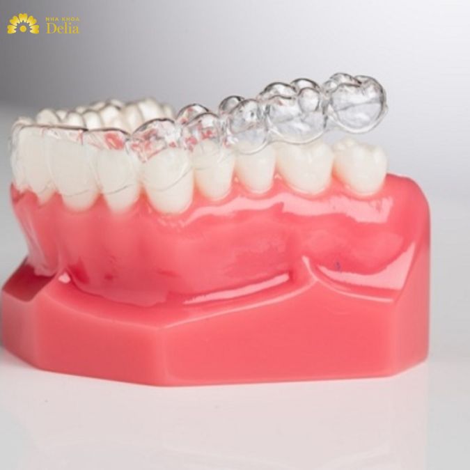 Niềng răng nhựa là lựa chọn phù hợp cho nhiều đối tượng