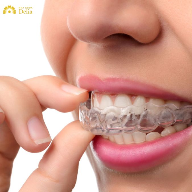 Niềng răng Invisalign
