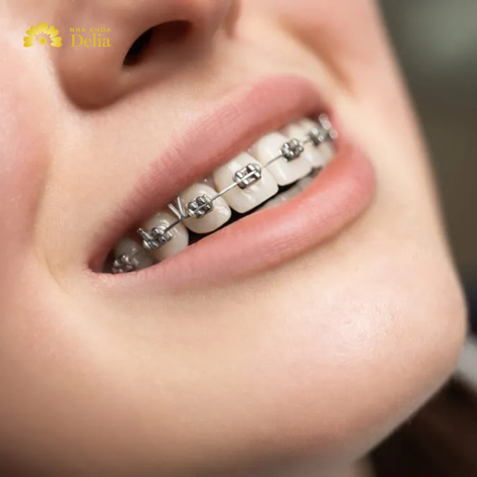 Niềng răng rẻ nhất là các loại niềng răng mắc cài kim loại với mức giá trung bình khoảng 35 - 45 triệu VNĐ cho 2 hàm. 