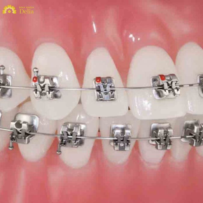 thời gian niềng răng mắc cài kim loại dao động từ 1 đến 3 năm