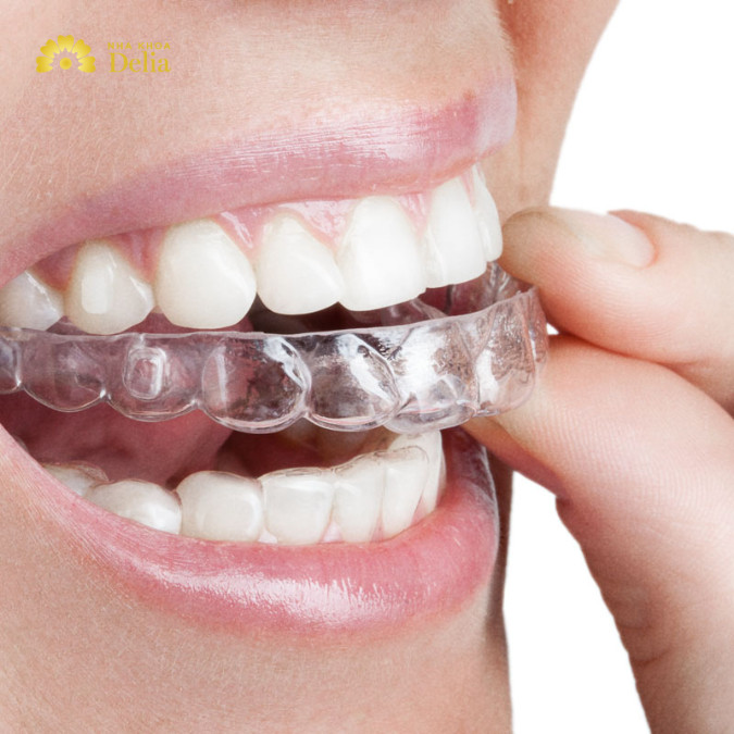 So với các phương pháp niềng răng truyền thống, niềng răng Silicon mang lại nhiều ưu điểm vượt trội như tính thẩm mỹ cao