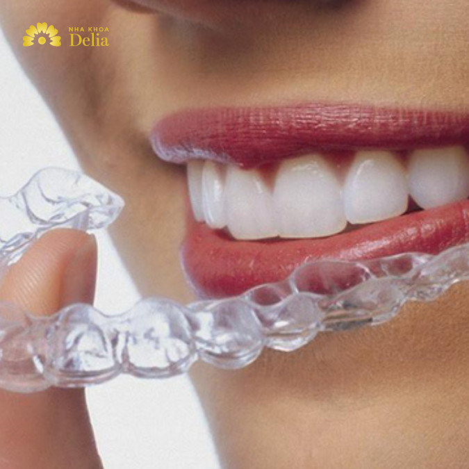 Niềng răng trong suốt Invisalign giá bao nhiêu? Bảng giá cập nhật 2024