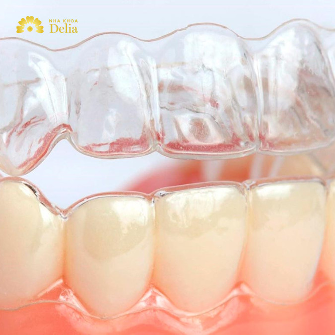 Review niềng răng trong suốt, kinh nghiệm niềng răng hiệu quả