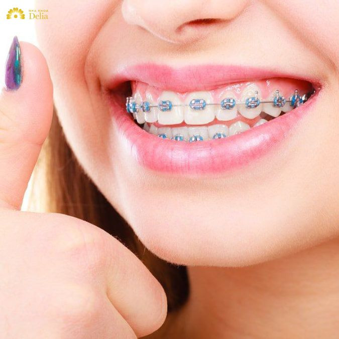 hiệu quả của việc niềng răng còn phụ thuộc vào mức độ nghiêm trọng của tình trạng lệch mặt