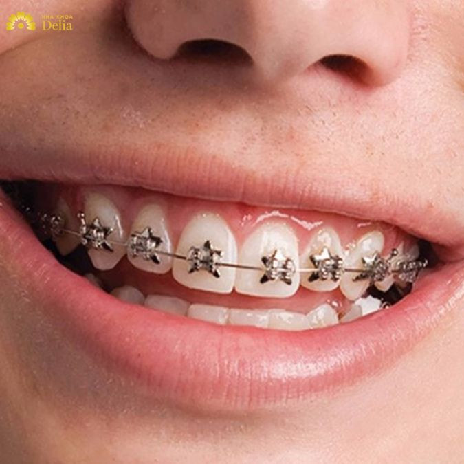Hiện nay, có nhiều phương pháp niềng răng móm khác nhau