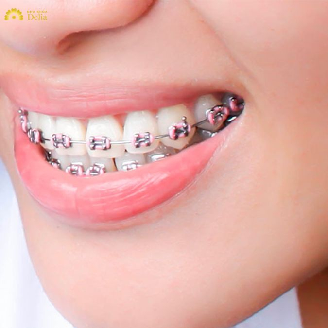 mắc cài kim loại đảm bảo hiệu quả điều trị cao