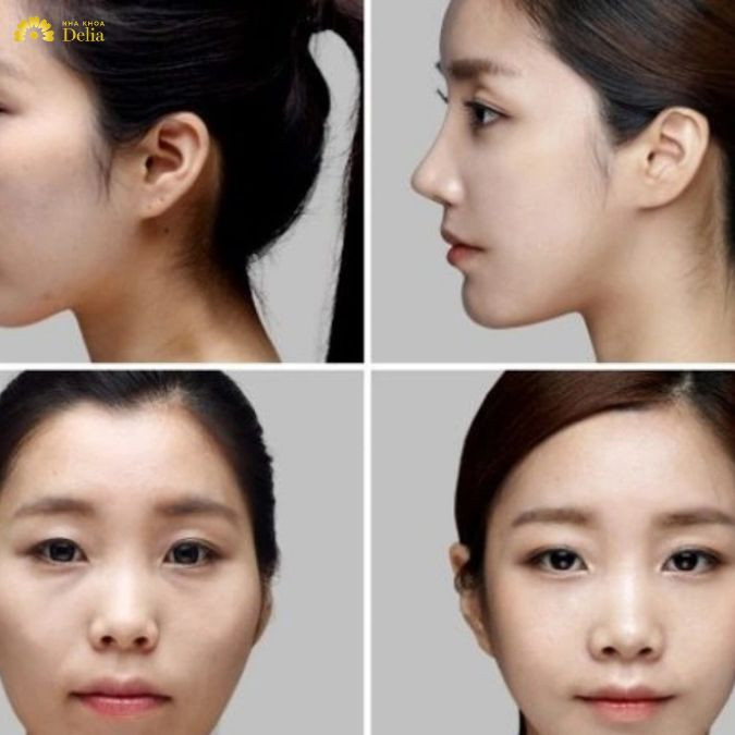hiệu quả của việc niềng răng còn phụ thuộc vào mức độ nghiêm trọng của tình trạng lệch mặt