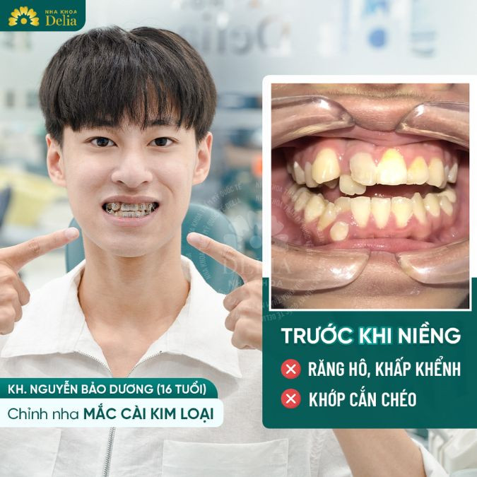 Muốn niềng răng hô nhanh chóng và đạt hiệu quả cao, việc lựa chọn một địa chỉ nha khoa uy tín là vô cùng quan trọng