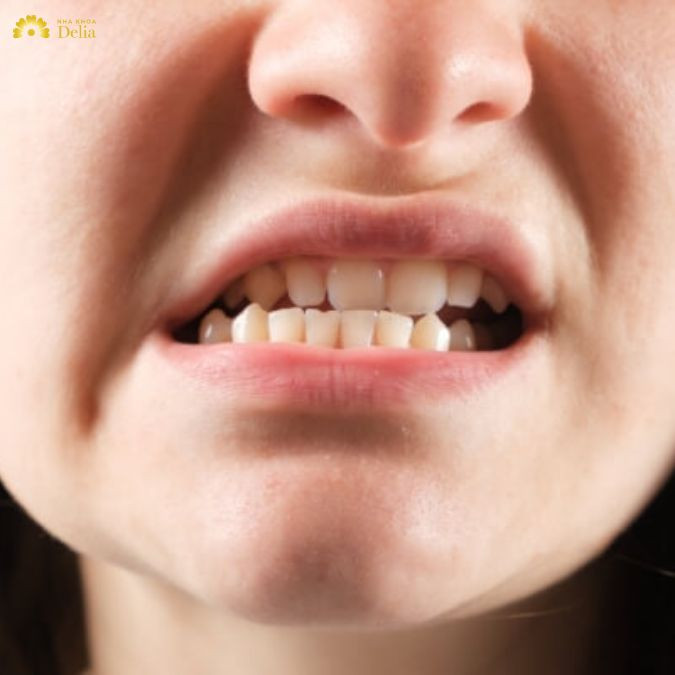 Mặt lệch do thói quen sinh hoạt