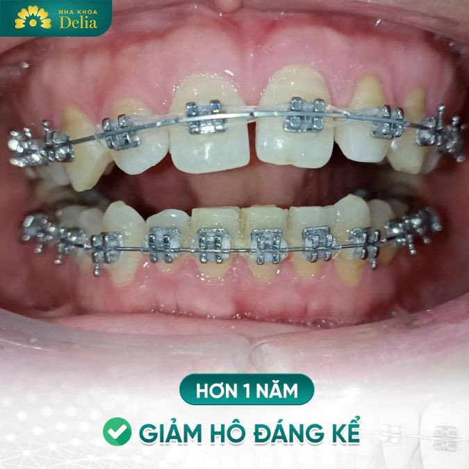 Răng hô nhẹ đơn thuần thường có thời gian niềng ngắn hơn so với các trường hợp răng hô kết hợp với hàm lệch lạc, sai khớp cắn