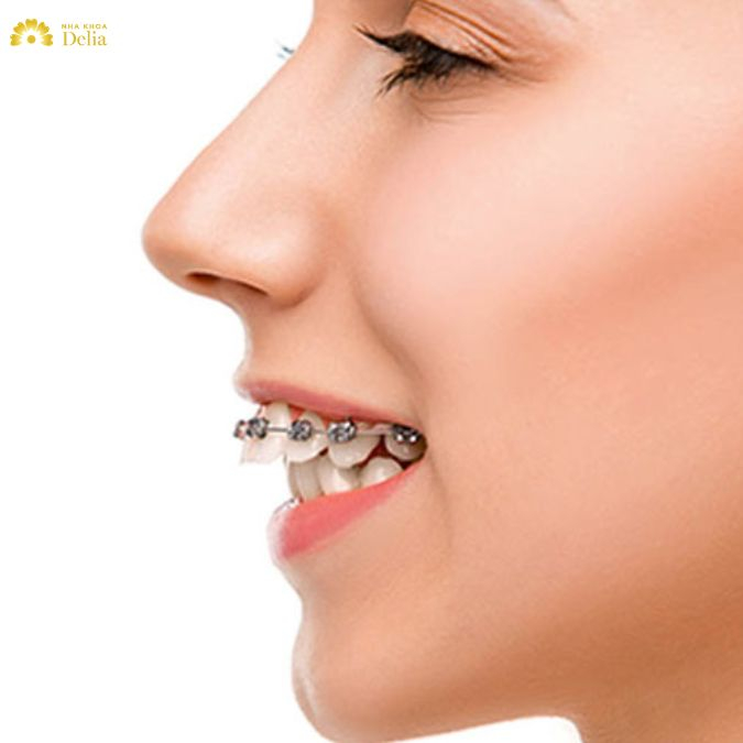 Bác sĩ có kinh nghiệm và tay nghề cao sẽ giúp quá trình niềng răng diễn ra nhanh chóng và hiệu quả hơn