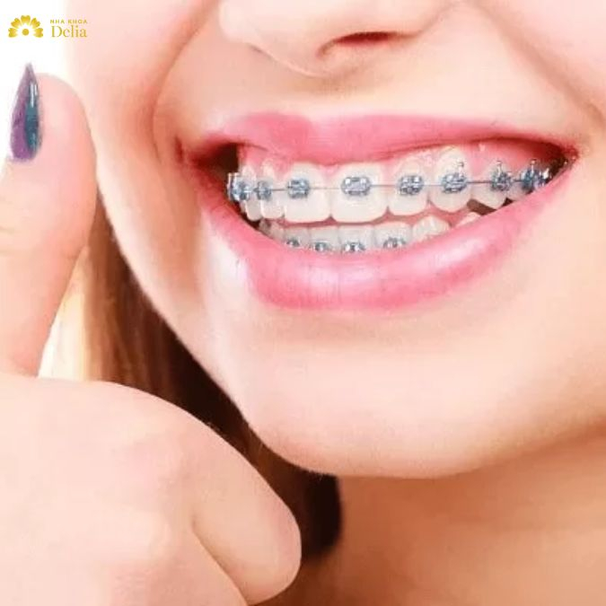 Trong đa số các trường hợp răng hô, đặc biệt là hô nặng, việc nhổ răng số 4 là cần thiết để tạo đủ khoảng trống giúp thu răng vào trong, khắc phục tình trạng hô