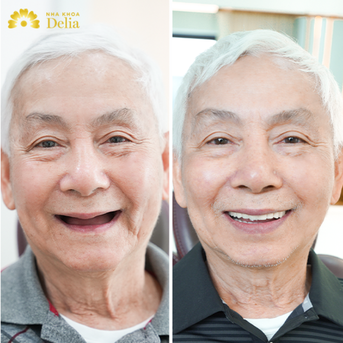 Trồng răng Bio Implant - Khôi phục ăn nhai và thẩm mỹ toàn diện