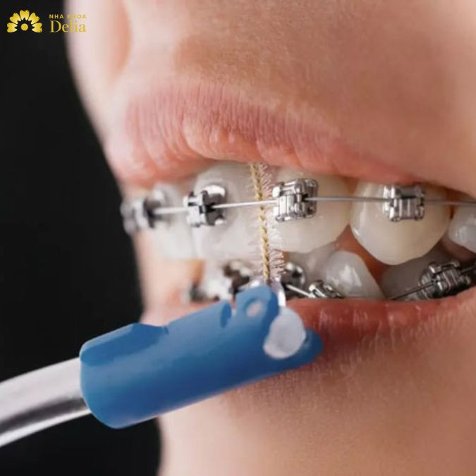 Mặc dù niềng răng không ảnh hưởng trực tiếp đến thai nhi nhưng việc niềng răng trong thời gian mang thai có thể gặp một số khó khăn và bất tiện