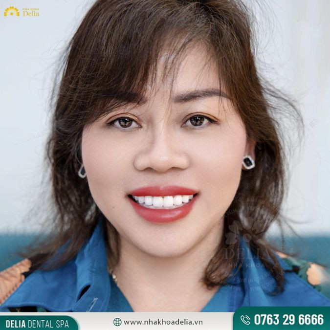 Mặt dán sứ Veneer - Giải pháp thẩm mỹ tối ưu