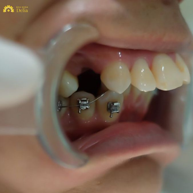 Mắc cài kim loại có ưu điểm là chi phí thấp, lực kéo mạnh nhưng lại kém thẩm mỹ