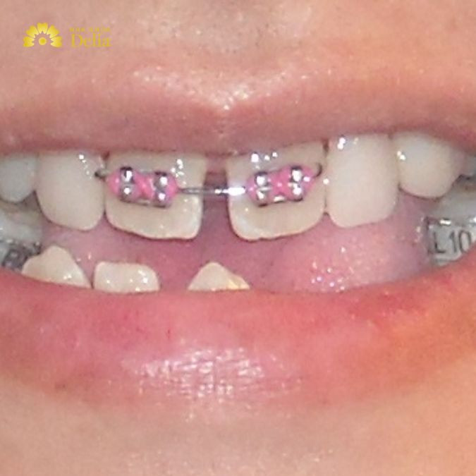Niềng một cái răng là quá trình chỉnh hình nha khoa tập trung vào việc điều chỉnh và sắp xếp lại vị trí của một răng cụ thể trên cung hàm