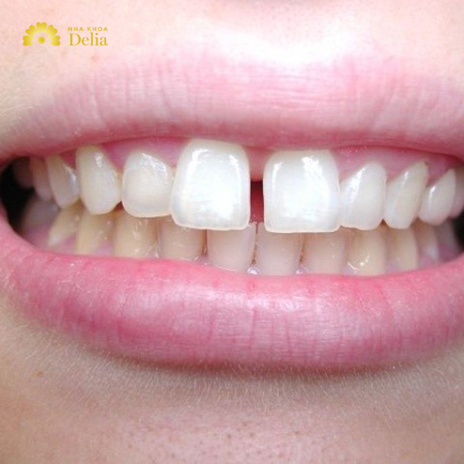 Niềng 2 răng cửa bị lệch giá bao nhiêu tiền, đắt hay rẻ?