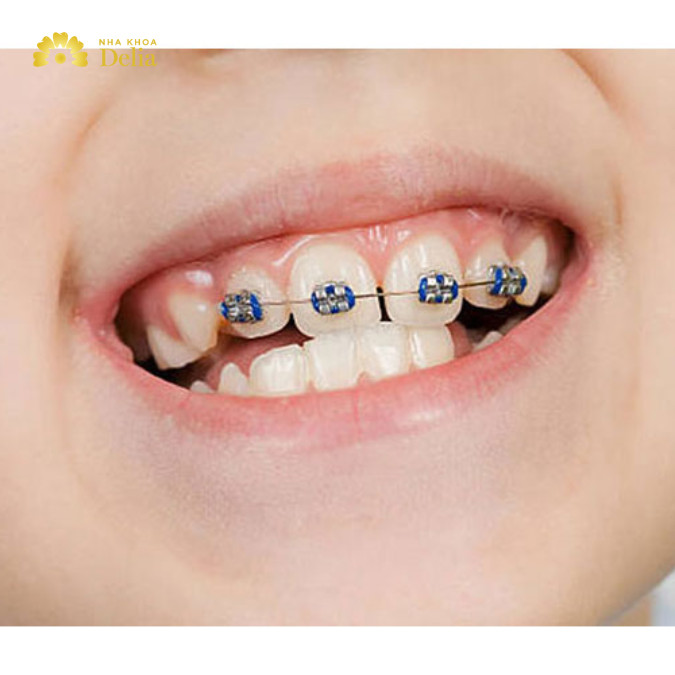 Niềng răng cửa bị lệch là một trong những giải pháp thẩm mỹ và chức năng phổ biến nhất trong lĩnh vực nha khoa.